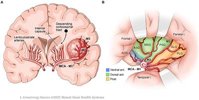 What is the cognitive footprint of insular glioma?